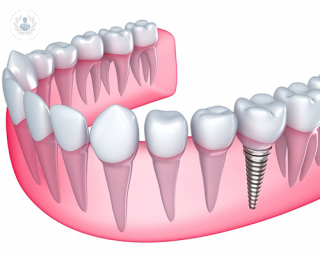 implante dental de zirconio