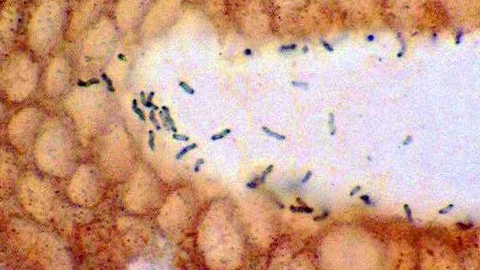 Helicobacter Pylori en heces